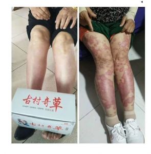 古村奇草抑菌膏可以调理牛皮癣吗