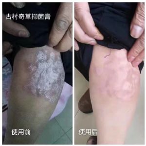 古村奇草通络抑菌膏效果真那么好吗？批发价是多少？怎么代理？