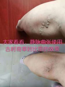 古村奇草通络膏主要成分是什么？古村奇草有副作用吗？